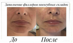Контурна пластика Дерматолог косметолог Елена Белая Церковь