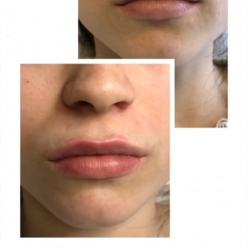 Контурна пластика
                    Дерматолог косметолог Елена Белая Церковь