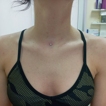 Установка микродермала в яремной ямке