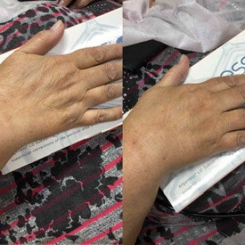 Омоложение кистей рук-Algeness
Это биоматериал легкой плотн