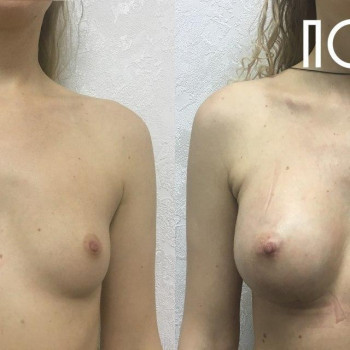 Маммопластика