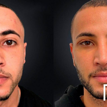 Ринопластика