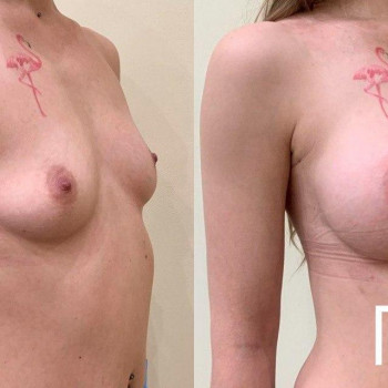 Маммопластика