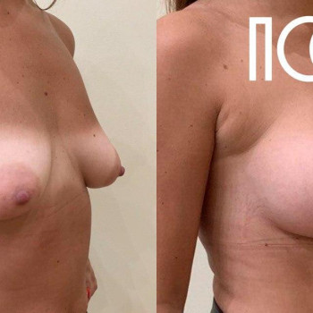 Маммопластика