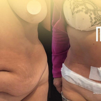 Абдоминопластика с укреплением мышц передней брюшной стенки