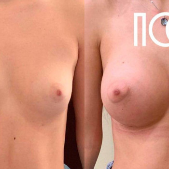 Маммопластика