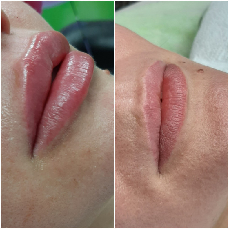 Аугментація губ, губи бантиком, натуральний об'єм, вікові, фото -  Елена