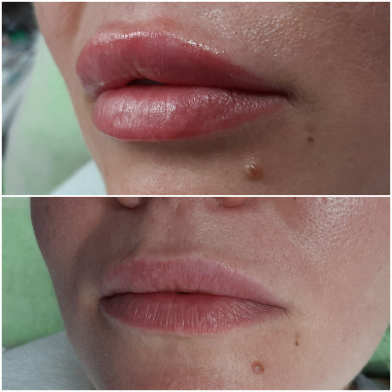 Аугментація губ, губи бантиком, натуральний об'єм, вікові, фото -  Елена