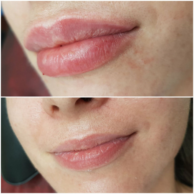 Аугментація губ, губи бантиком, натуральний об'єм, вікові, фото -  Елена