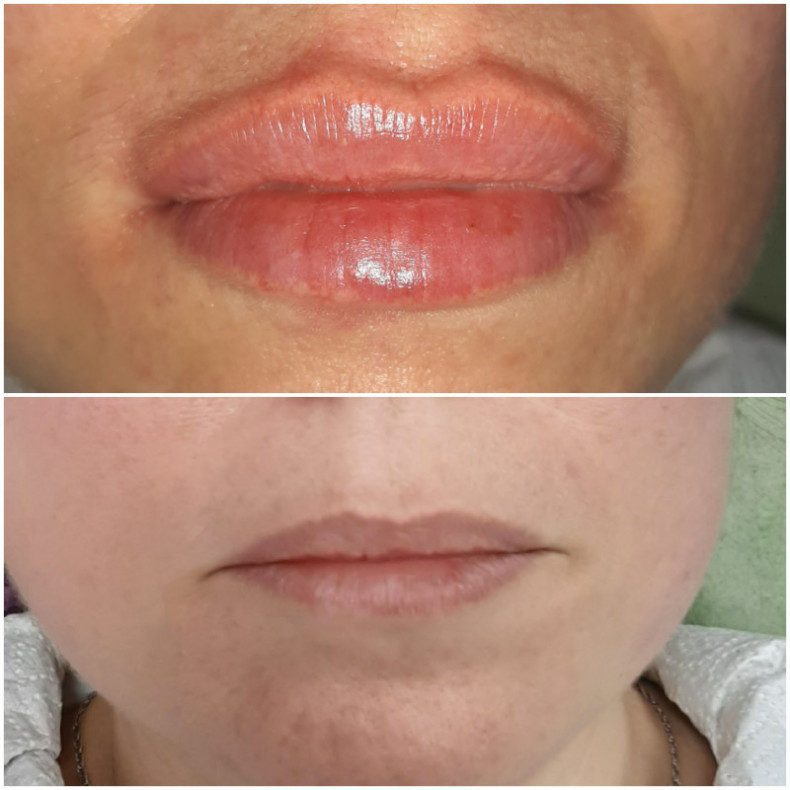 Аугментація губ, губи бантиком, натуральний об'єм, вікові, фото -  Елена