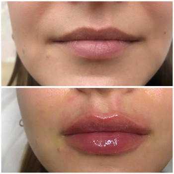 Увеличение губ