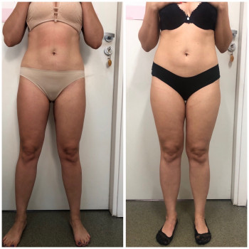 Курс вакуумного массажа