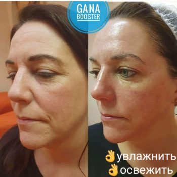 Одна процедура результат на месяцы