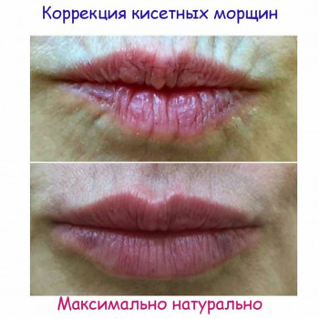Корекція кісетних зморшок 
 #губызапорожье
 #губизапоріжжя
 #губызп