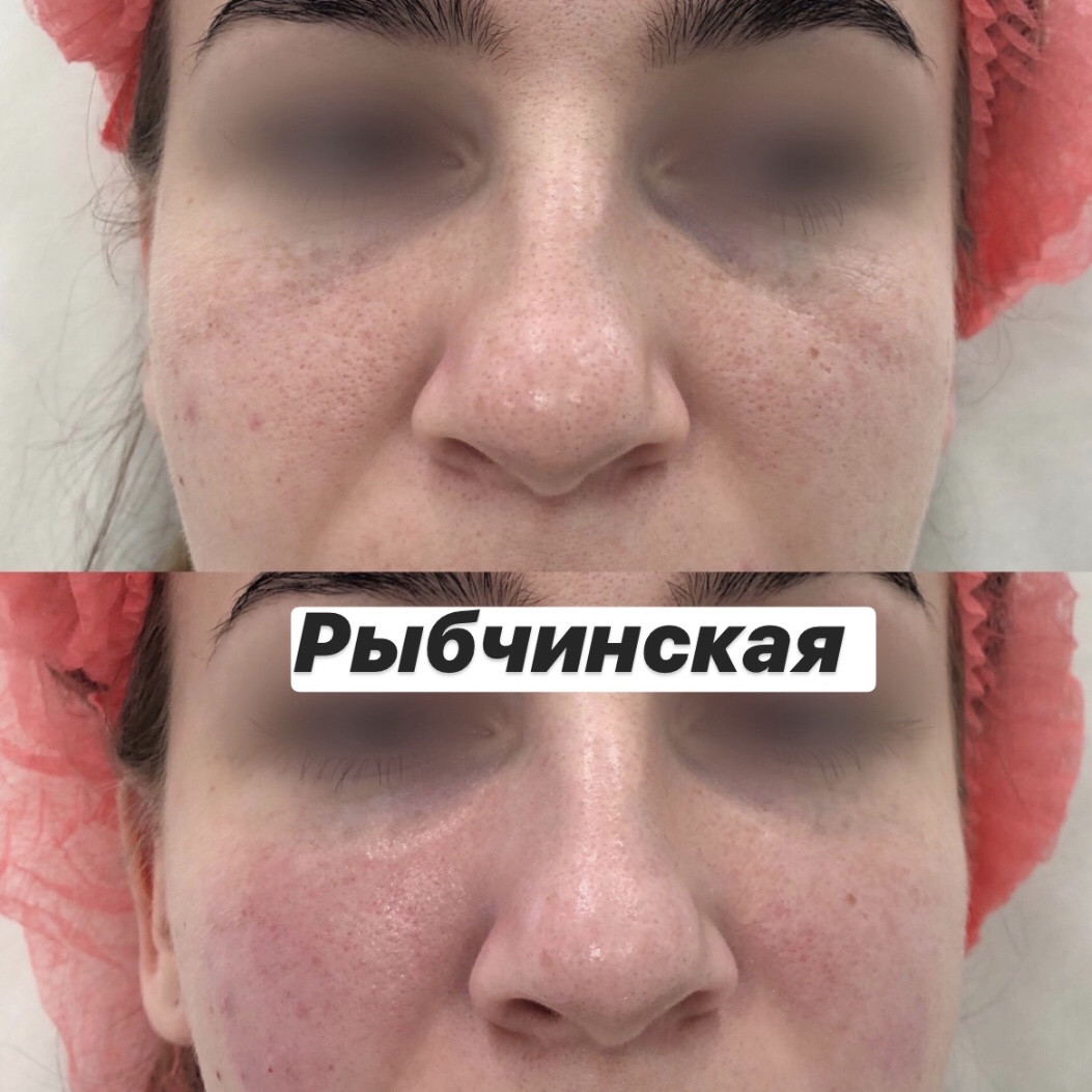 Полинуклеотиды отзывы до и после