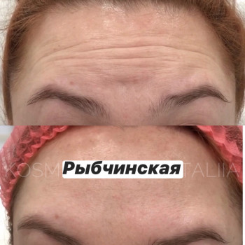 Ботулотоксин
                    Врач-косметолог Наталия Киев