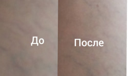 Ederslis- кріогенна процедура для зняття набряковості тіла Косметолог-естетист Светлана Київ