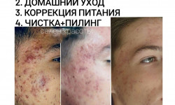 Чистка лица, пилинг, лечение акне Салон красоты Beauty Line Запорожье