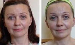 Вакуумный массаж лица Косметолог-естетист Маргарита Київ