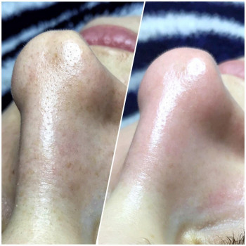 Чистка лица
                    Врач-косметолог Алина Одесса