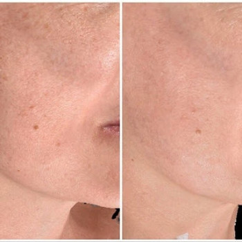 Осветление пигментных пятен.
Рекомендовано при фотостарении