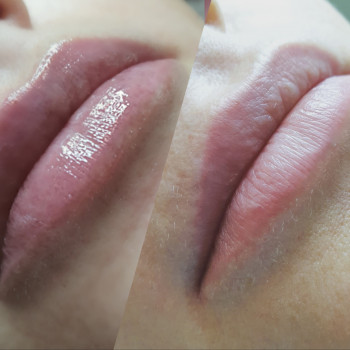 Контурная пластика губ juvederm