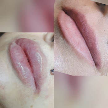 Аугментация губ