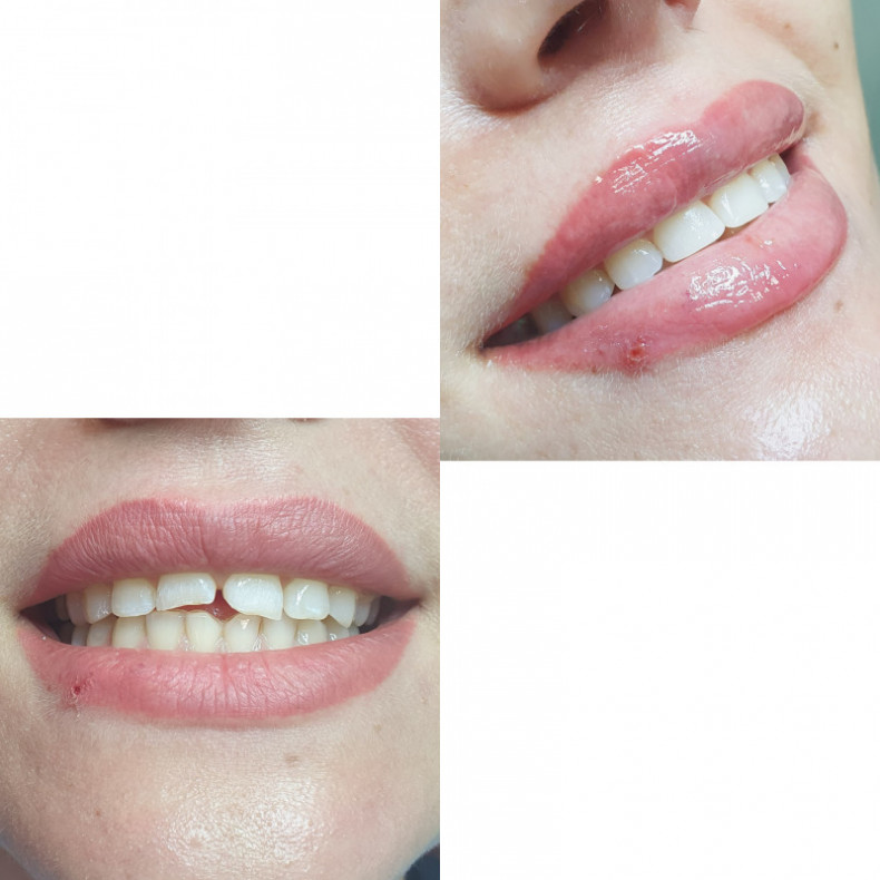 Художественная реставрация зубов
Аугментация губ juvederm 0., фото - Косметолог Олена Журба