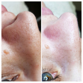 Атравматичная чистка лица