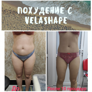 Velashape
                    Косметологічний центр Kryshtal beauty Вишневе