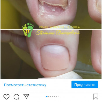 Протезирование ногтей