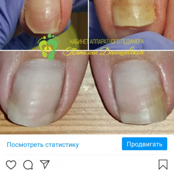 Грибок ногтей