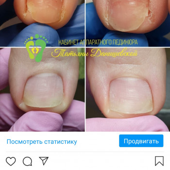 Грибок ногтя