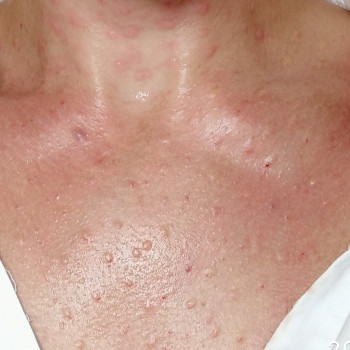 Плазмоліфтинг
                    Врач-косметолог Наталия Сумы