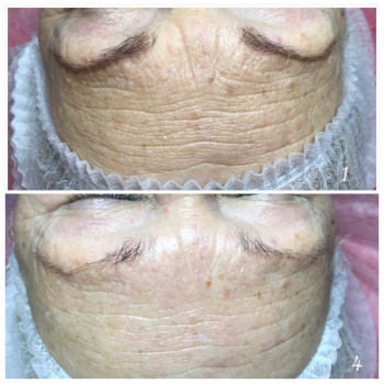 4 сеанса неинвазивной карбокситерапии