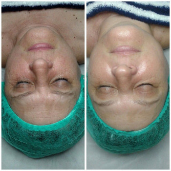 1 детокс процедура