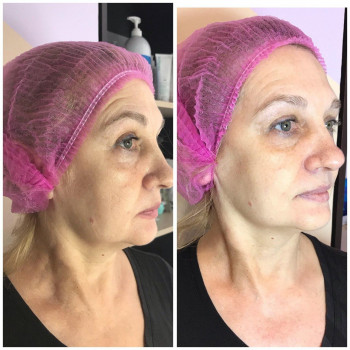 Апаратна косметологія.1 сеанс