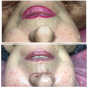 Пропрацювання кистних зморшок. 4 сеанса