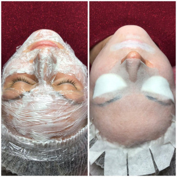 Процедура 2в1. УЗ чистка+карбокситерапія