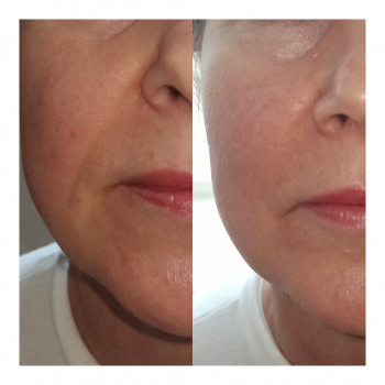 Плазмоліфтинг
                    Врач-косметолог Наталия Сумы