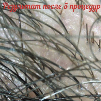 после 5 процедур криотерапии с нанесением лосьона