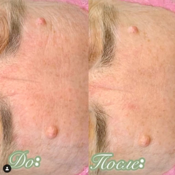 Карбокситерапия