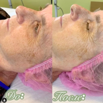 Карбокситерапия