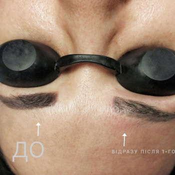 Видалення татуажу/тату лазером
                    Мастер перманентного макияжа Аліна Ивано-Франковск