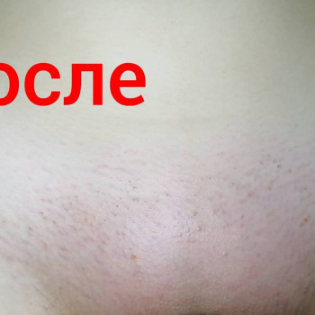 Глубокое бикини
                    Майстер депіляції Олександра Палагіцька Черкаси