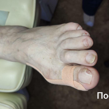 Онихолизис