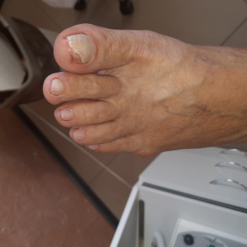 Онихомикоз