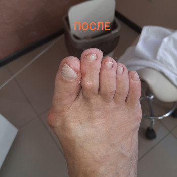 Зачистка онихолизиса