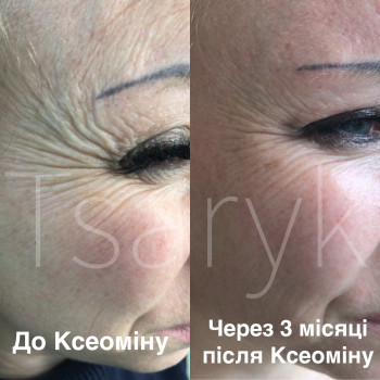 Ін‘єкції ботулотоксину (Ксеомін, Ботокс, Диспорт)
                    Косметолог-инъекционист Ірина Черновцы