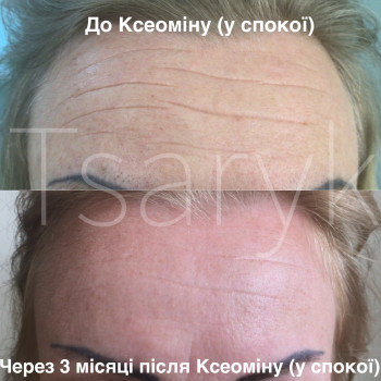 Ін‘єкції ботулотоксину (Ксеомін, Ботокс, Диспорт)
                    Косметолог-инъекционист Ірина Черновцы